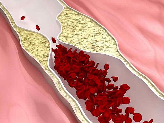 Grafische Darstellung einer Arterie mit Ablagerungen (Arteriosklerose), die den Blutfluss behindern